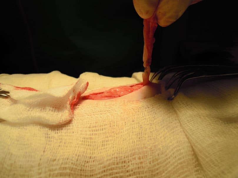 Close up of Umbilical Hernia Surgery